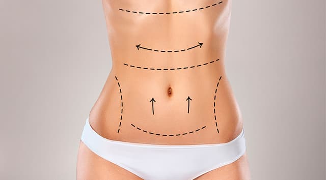 Abdominoplastia (cirugía de abdomen)