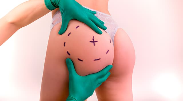 Implantes de glúteos (aumento con implantes de silicona)