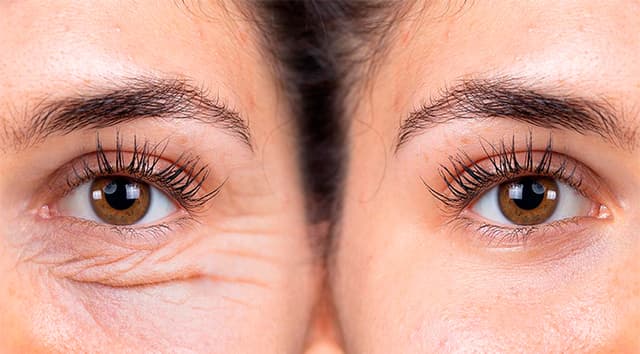 Blefaroplastia (cirugía de párpados)