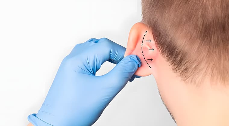 Otoplastia (cirugía de orejas)