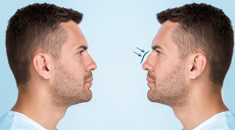 Rinoplastia (cirugía de nariz)