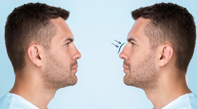 Rinoplastia (cirugía de nariz)